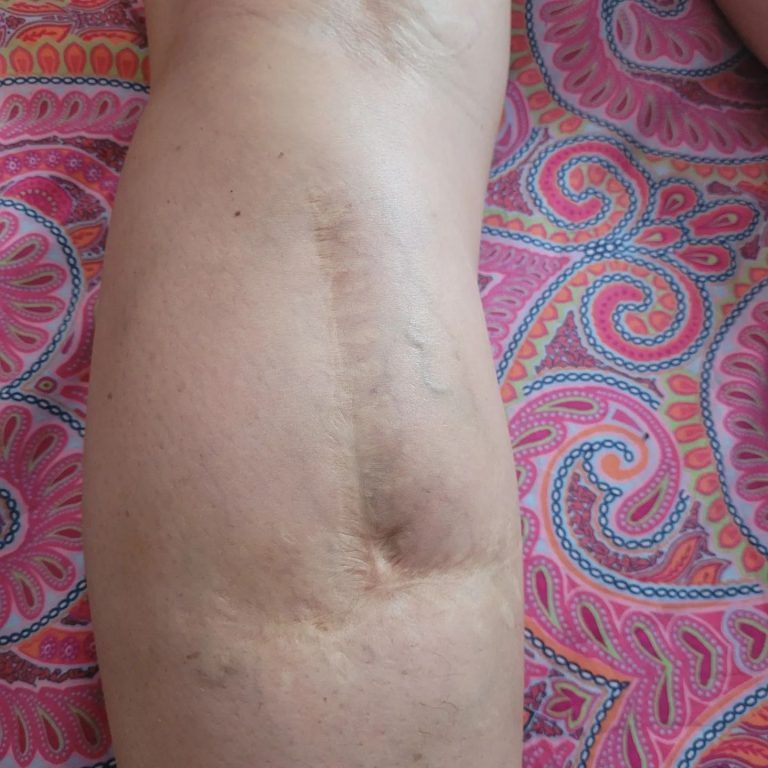 A 40 year old scar here with lots of wrinkling and puckering of the skin. The adhesions from the scar have resulted in ongoing hip, ankle & foot pain.